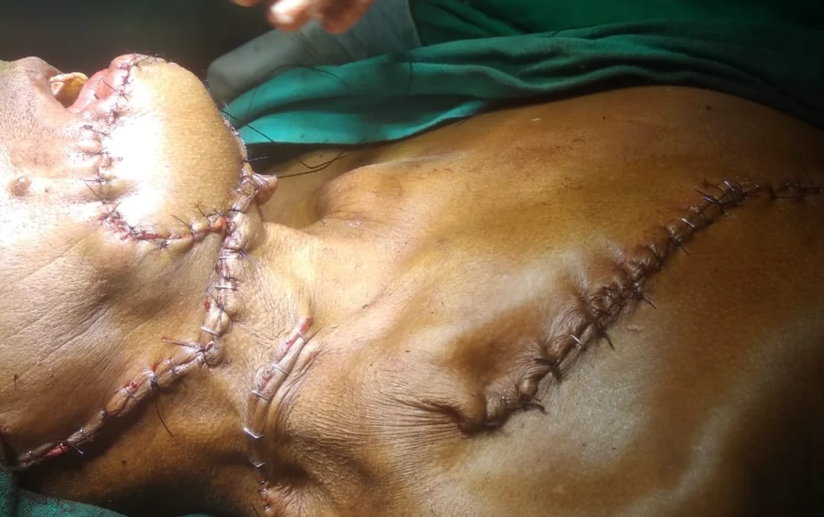 PMMC flap reconstruction post-operative result