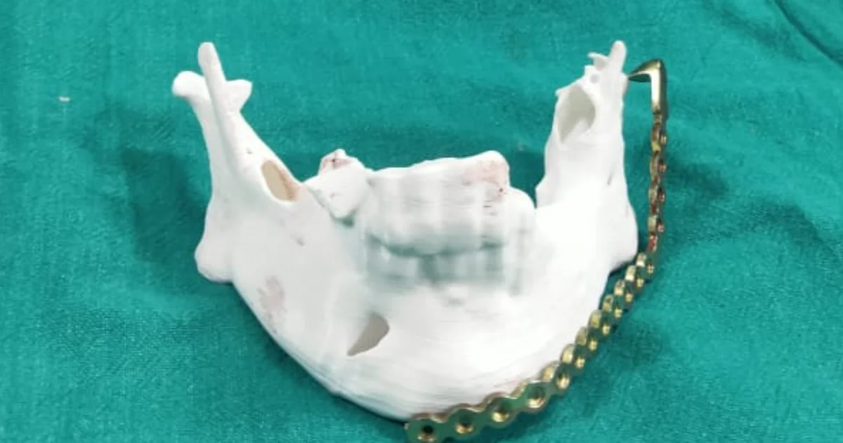 3D printed mandible model for fibula planning