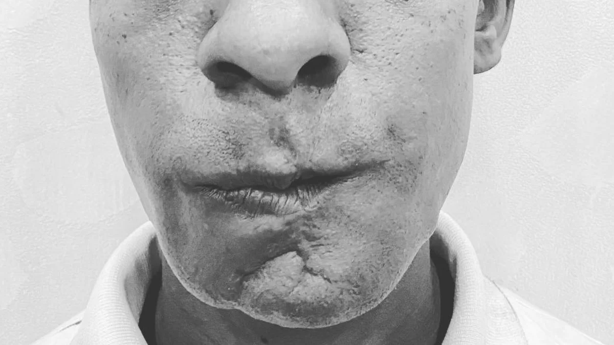 Comminuted mandible fracture post-operative result