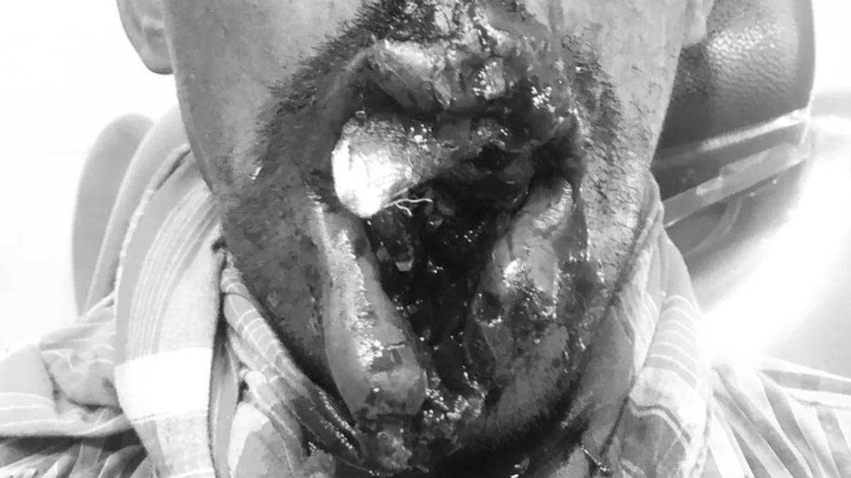 Comminuted mandible fracture pre-operative presentation