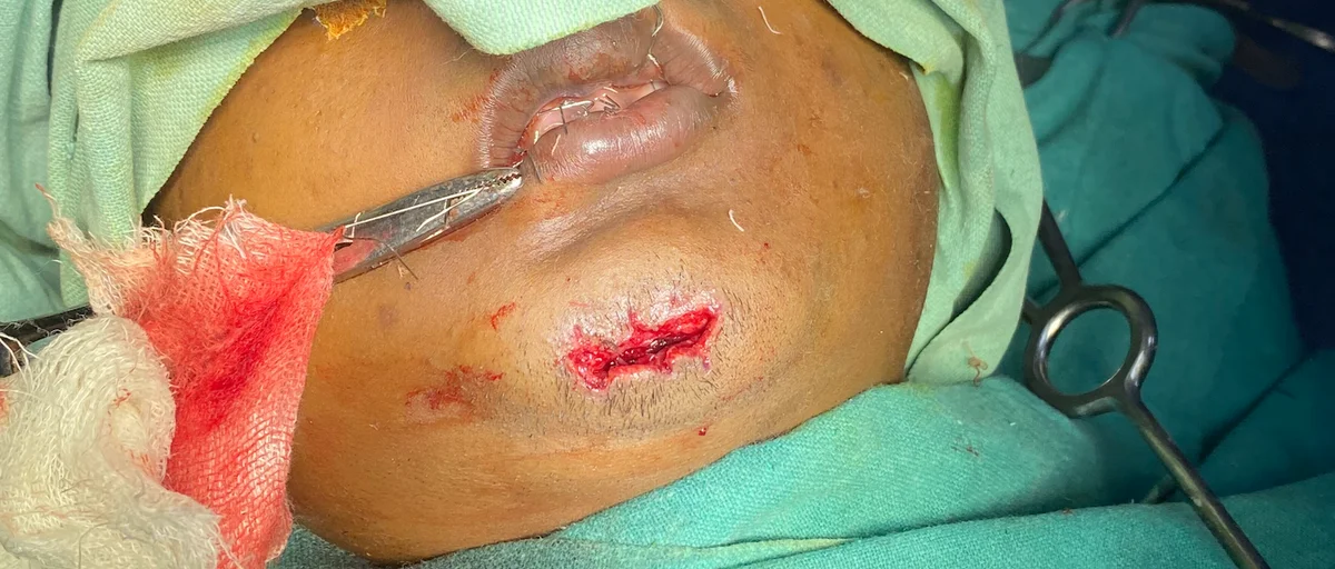 Mandible fracture pre-operative