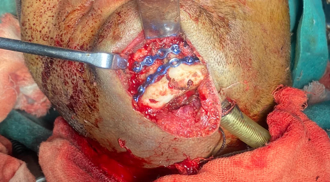 Mandible fixation in panfacial repair