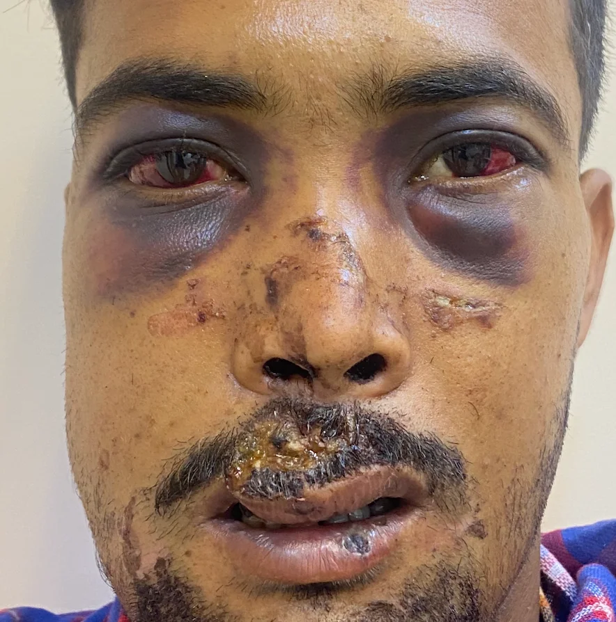 Panfacial fracture pre-operative