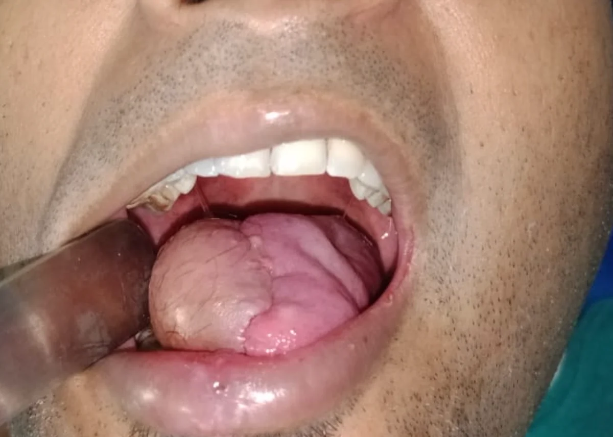 Tongue cancer post-operative reconstruction