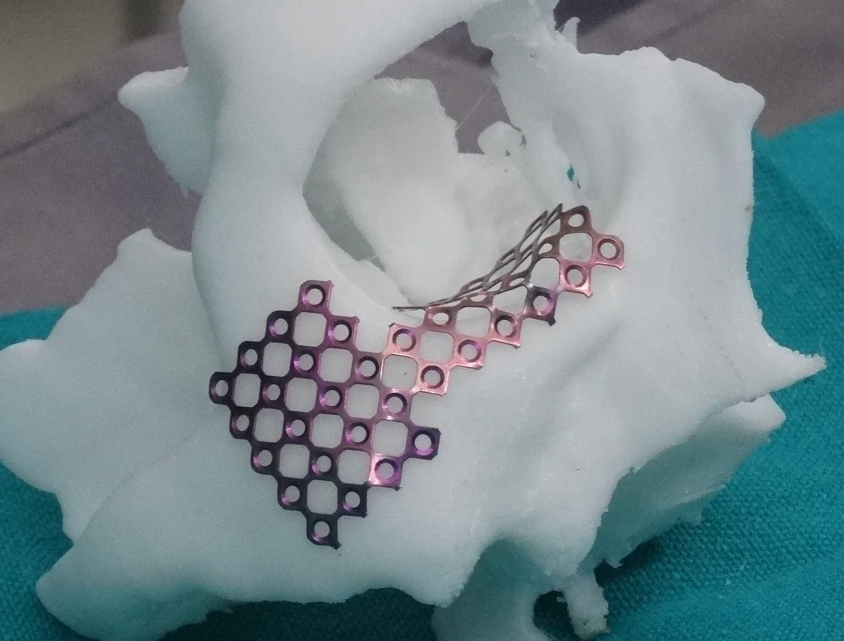 Titanium mesh adapted on 3D model