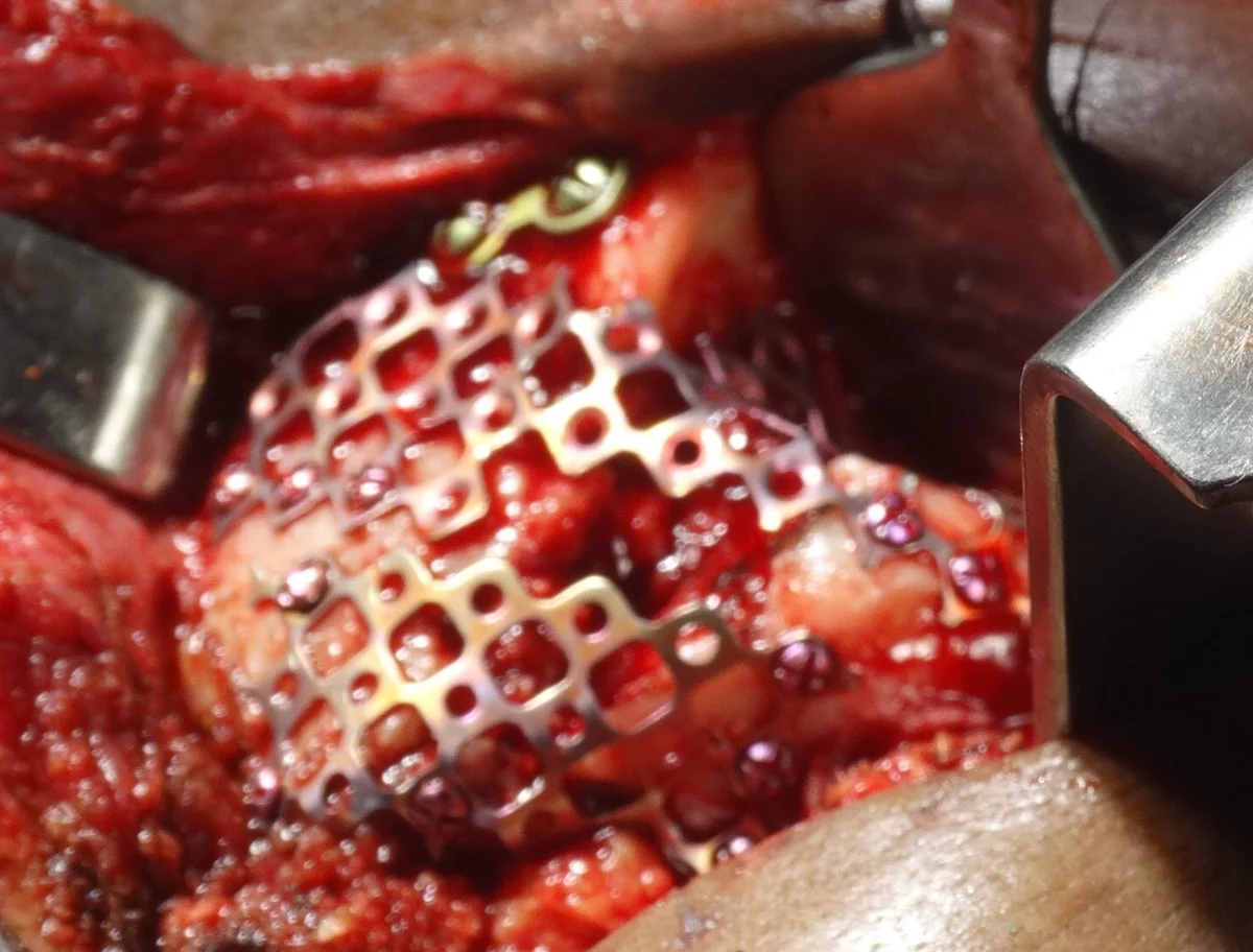Intra-operative zygomatic repair